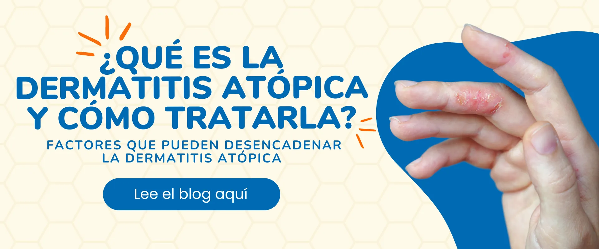 ¿Qué es la Dermatitis Atópica y cómo tratarla?